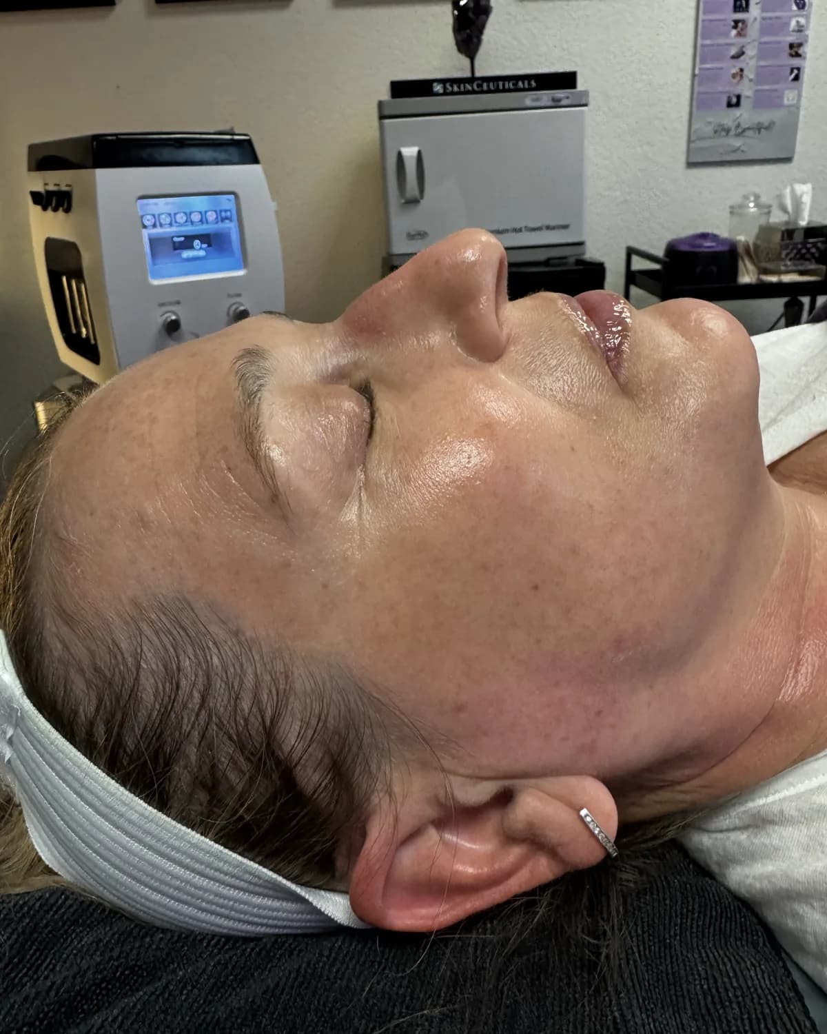 Dermaplane Facial, after treatment at AffiniDerm