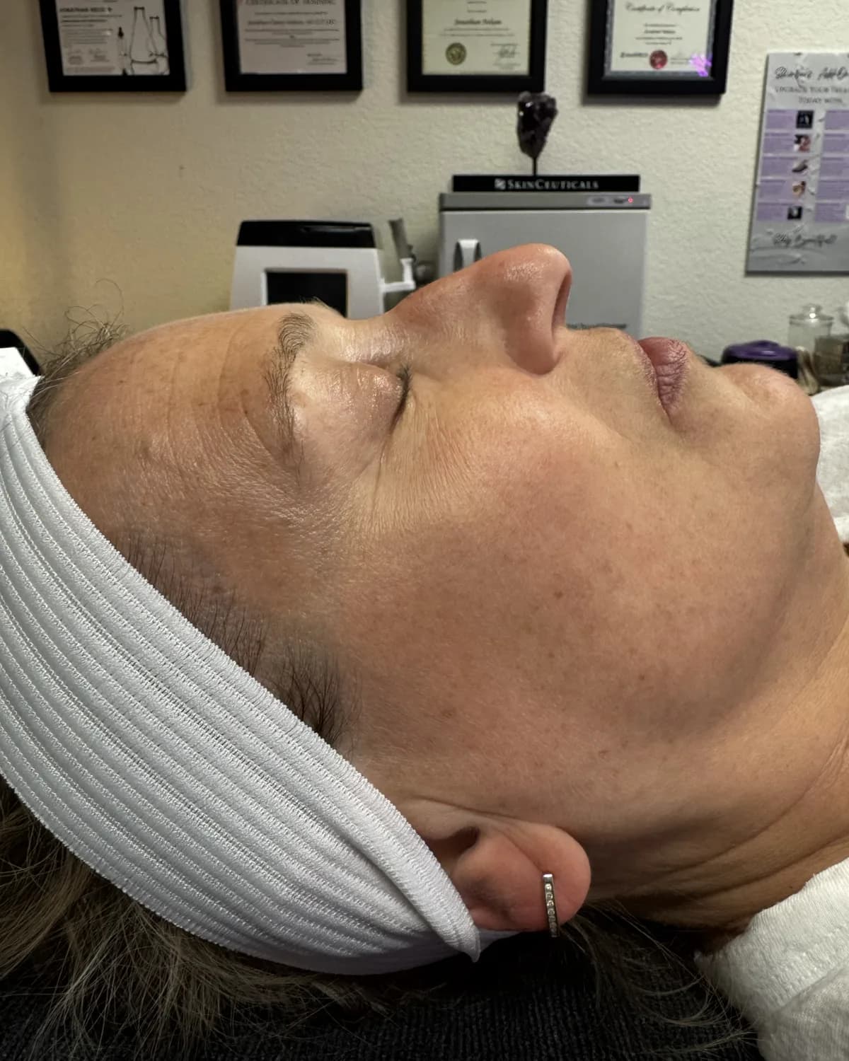 Dermaplane Facial, before treatment at AffiniDerm