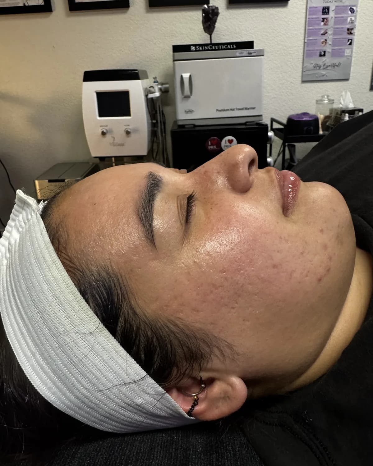 Dermaplane Facial, after treatment at AffiniDerm