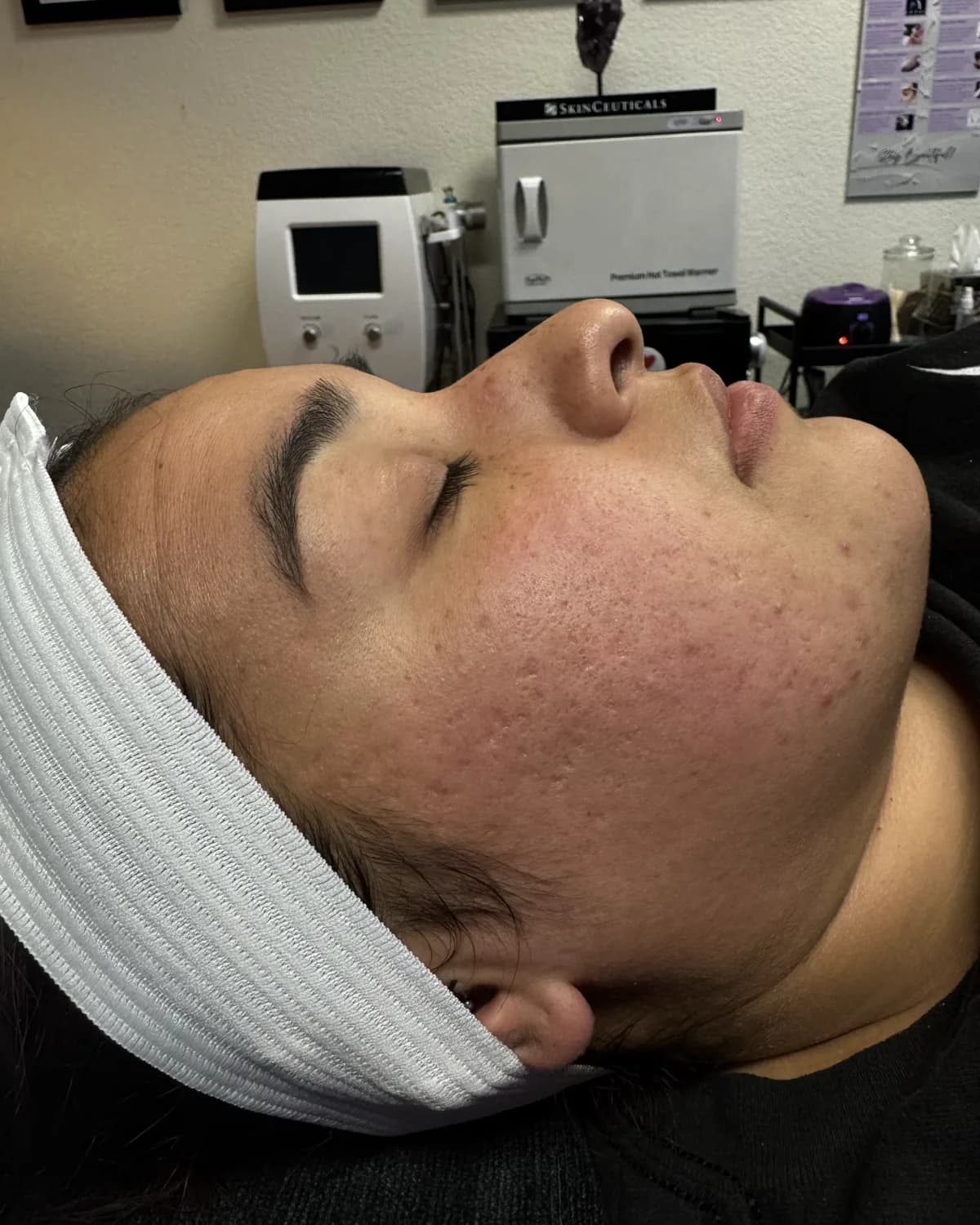 Dermaplane Facial, before treatment at AffiniDerm