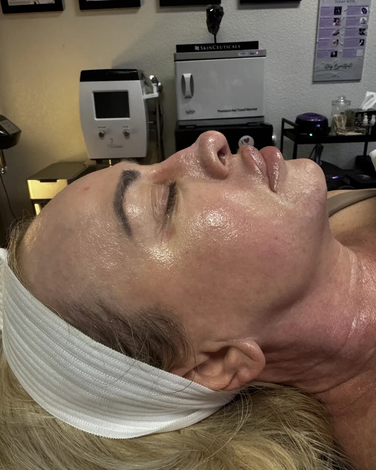 Lumecca IPL Rejuvenation, after treatment at AffiniDerm