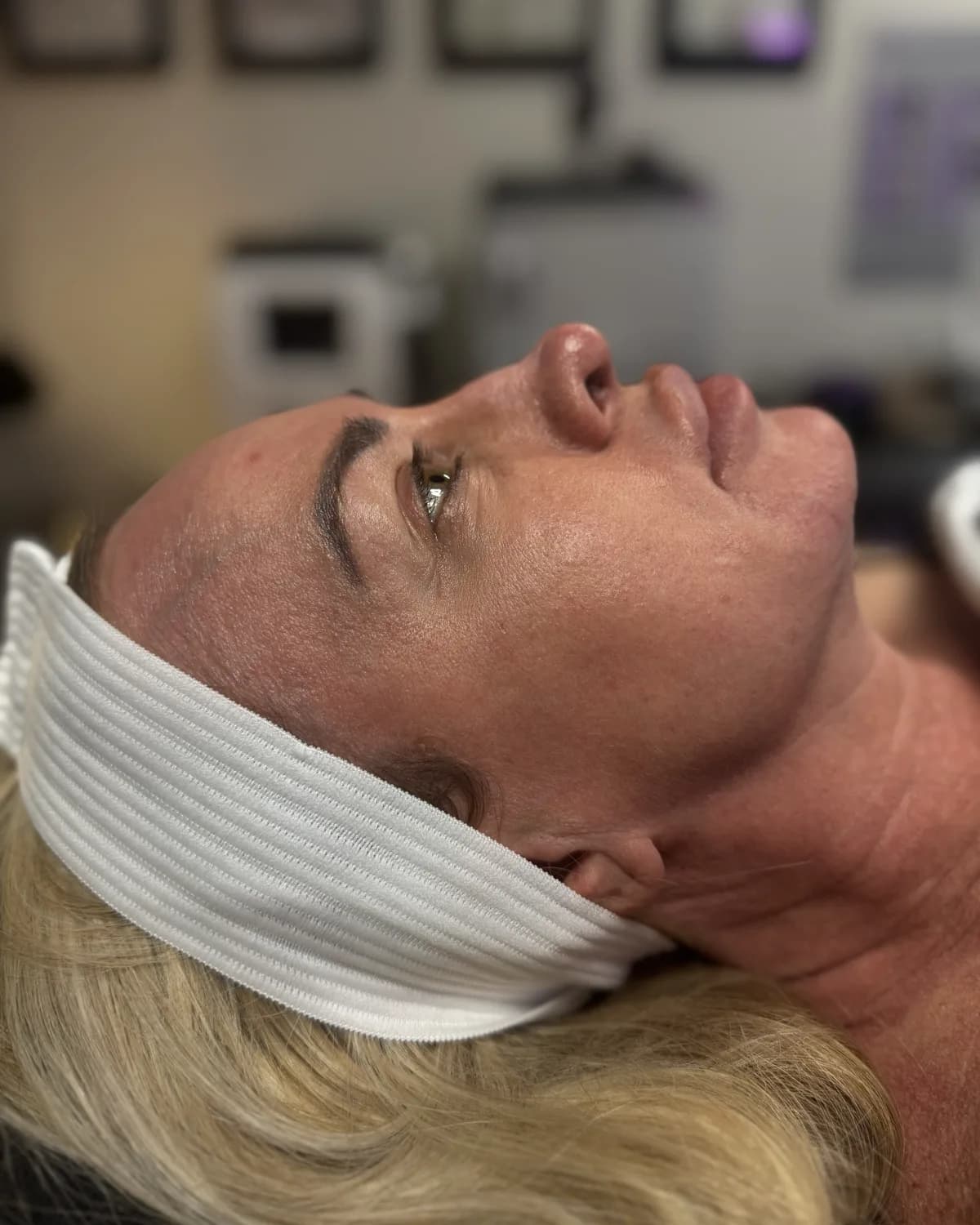 Lumecca IPL Rejuvenation, before treatment at AffiniDerm