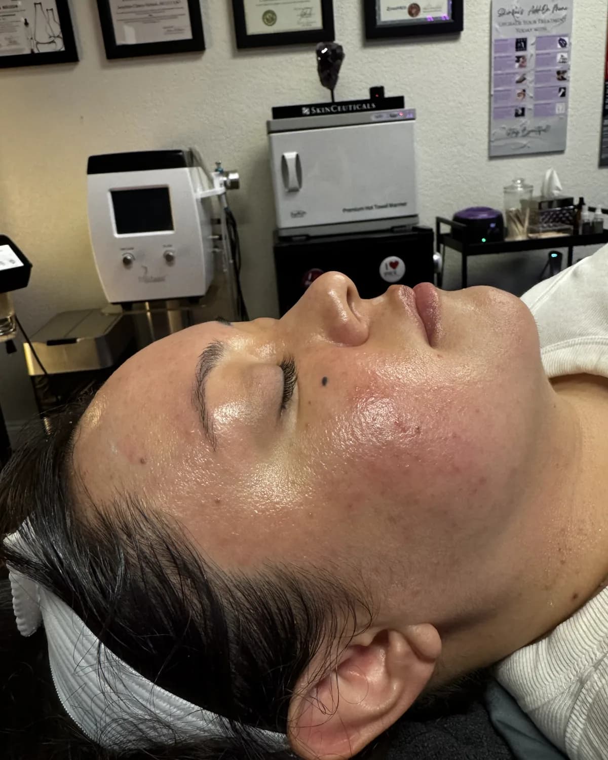 Lumecca IPL Rejuvenation, after treatment at AffiniDerm
