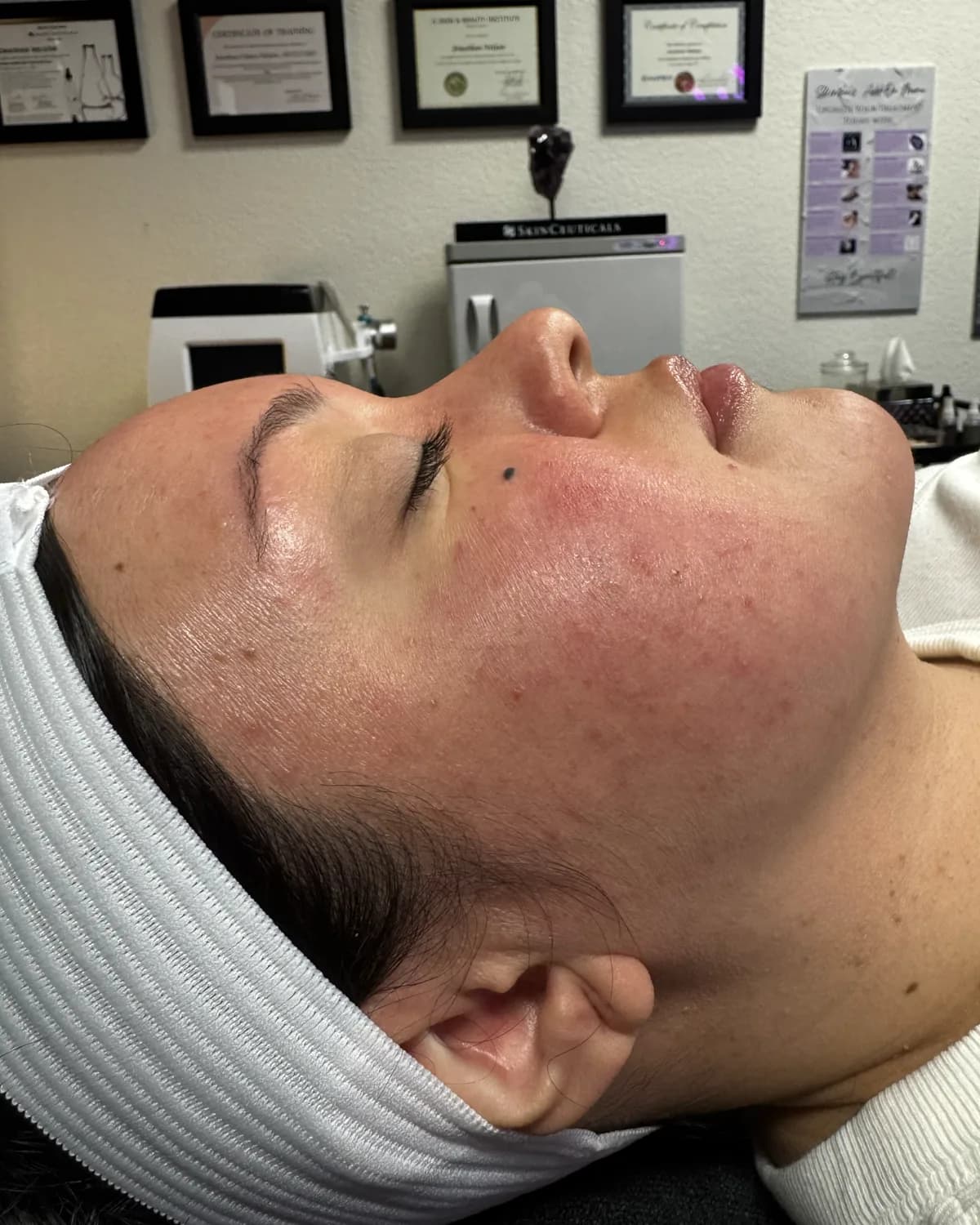 Lumecca IPL Rejuvenation, before treatment at AffiniDerm