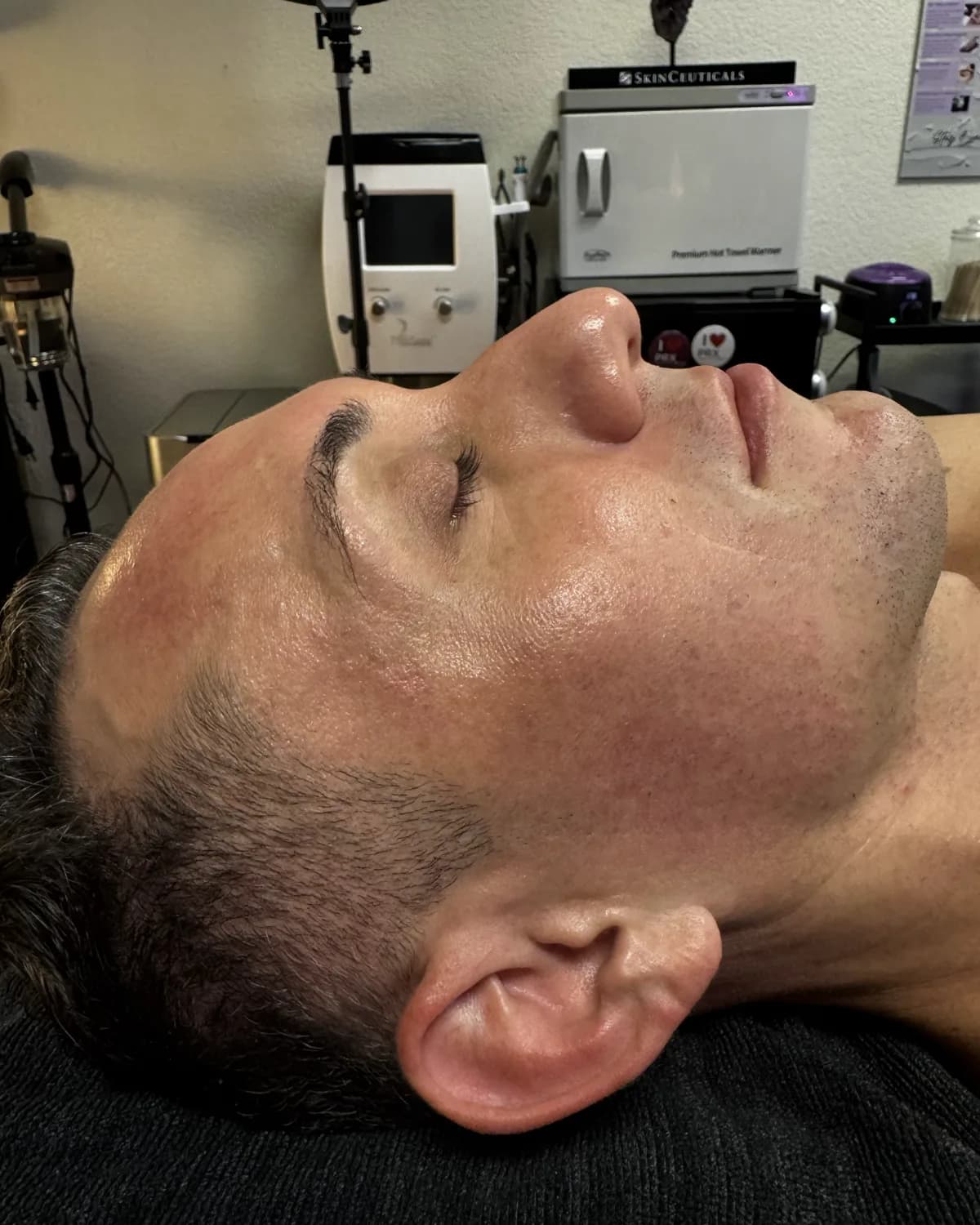 Lumecca IPL Rejuvenation, after treatment at AffiniDerm