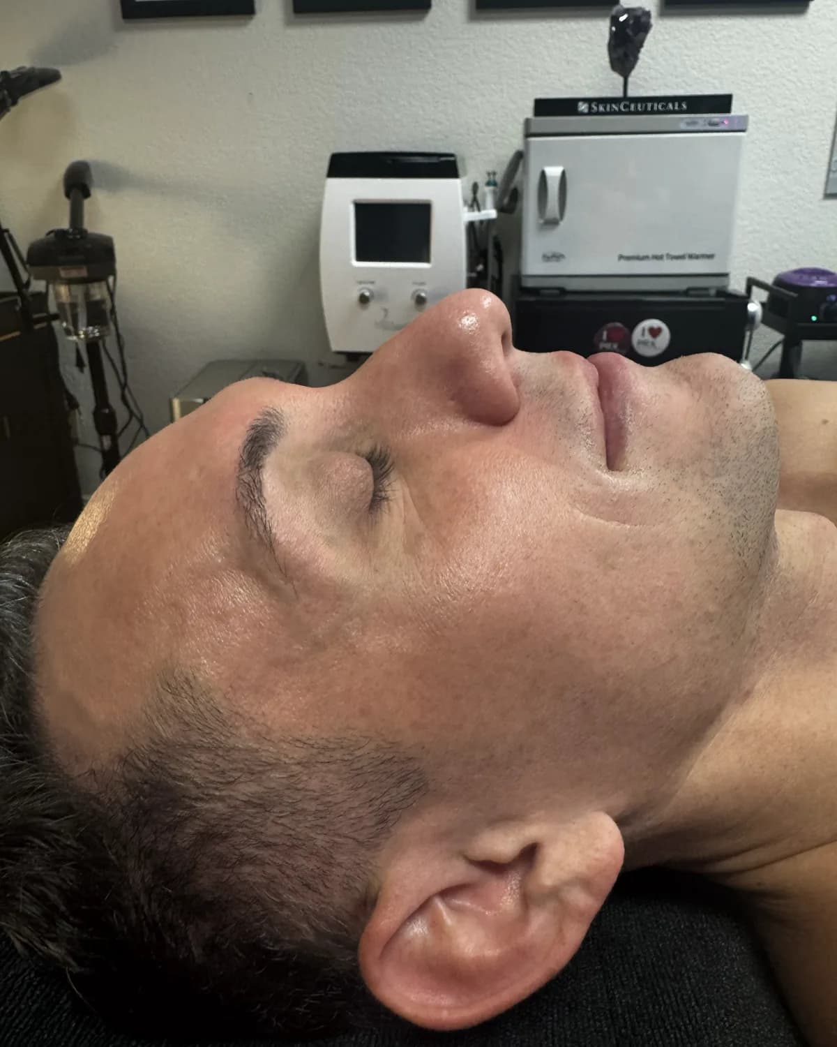 Lumecca IPL Rejuvenation, before treatment at AffiniDerm