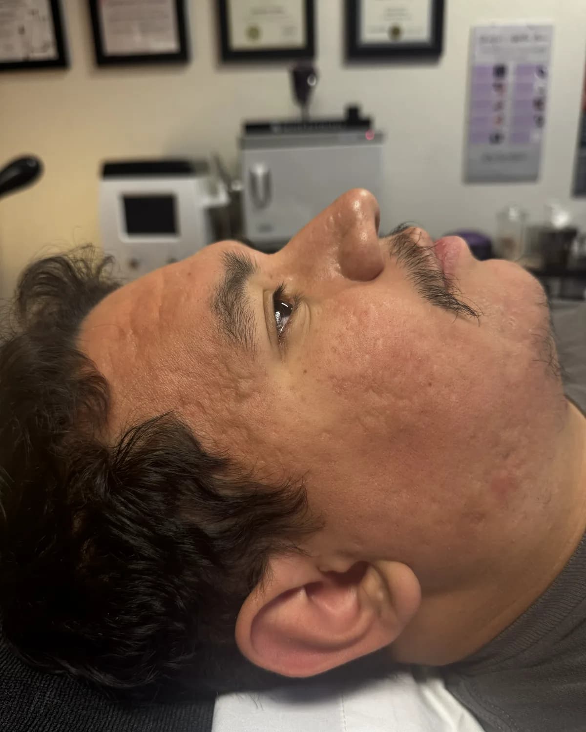 Microneedling, after treatment at AffiniDerm