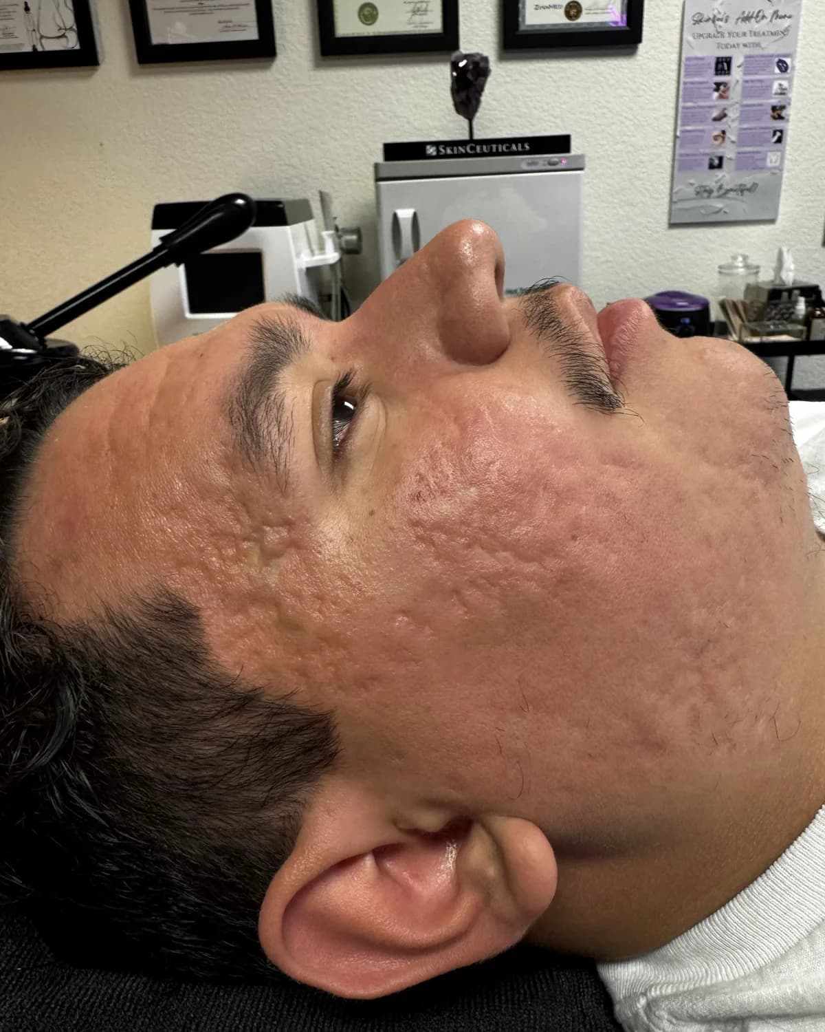 Microneedling, before treatment at AffiniDerm