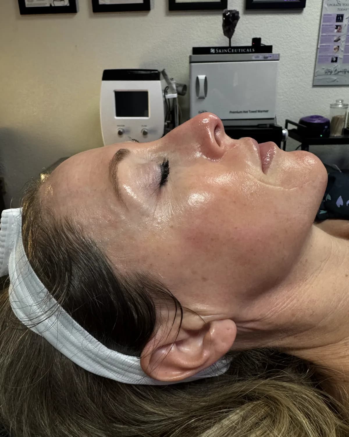 Microneedling, after treatment at AffiniDerm
