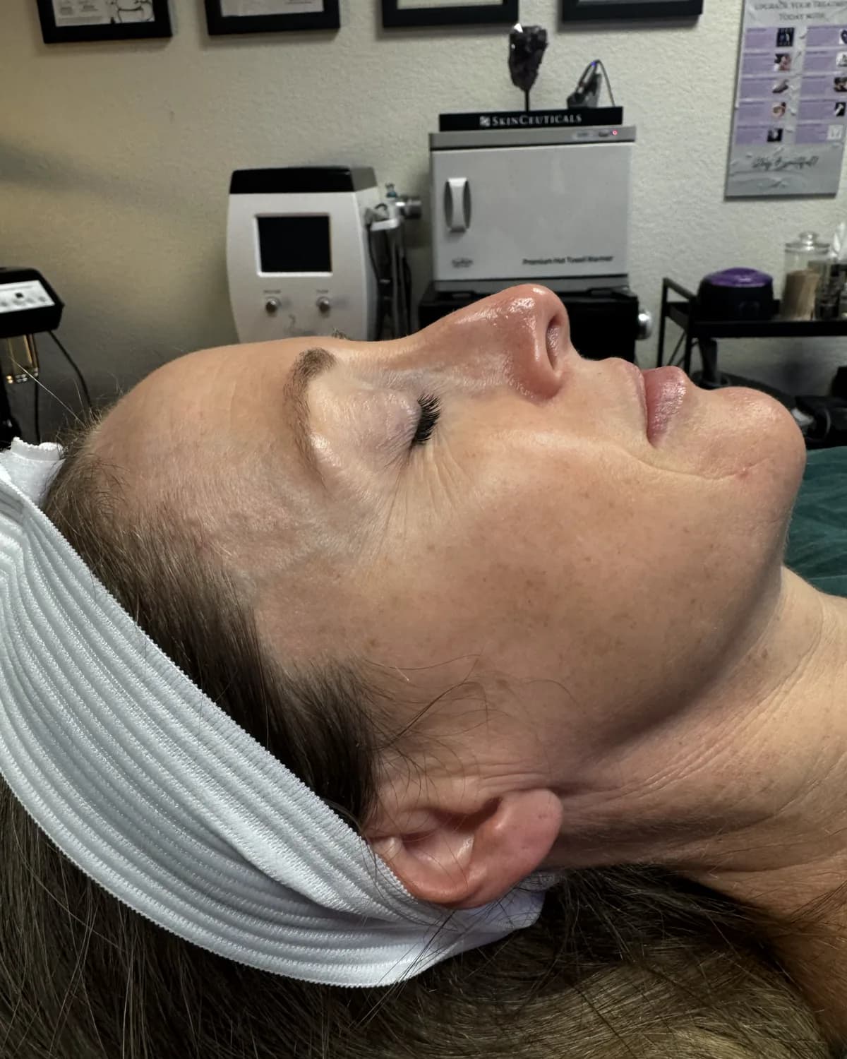 Microneedling, before treatment at AffiniDerm