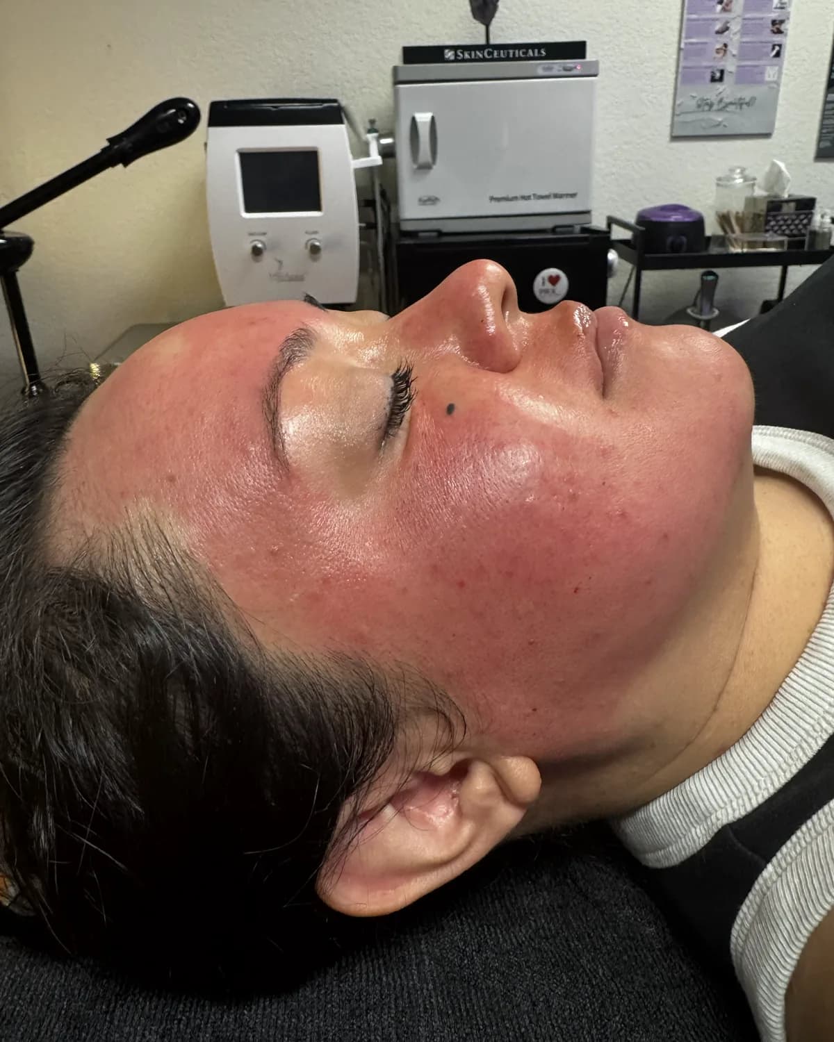 Microneedling, after treatment at AffiniDerm