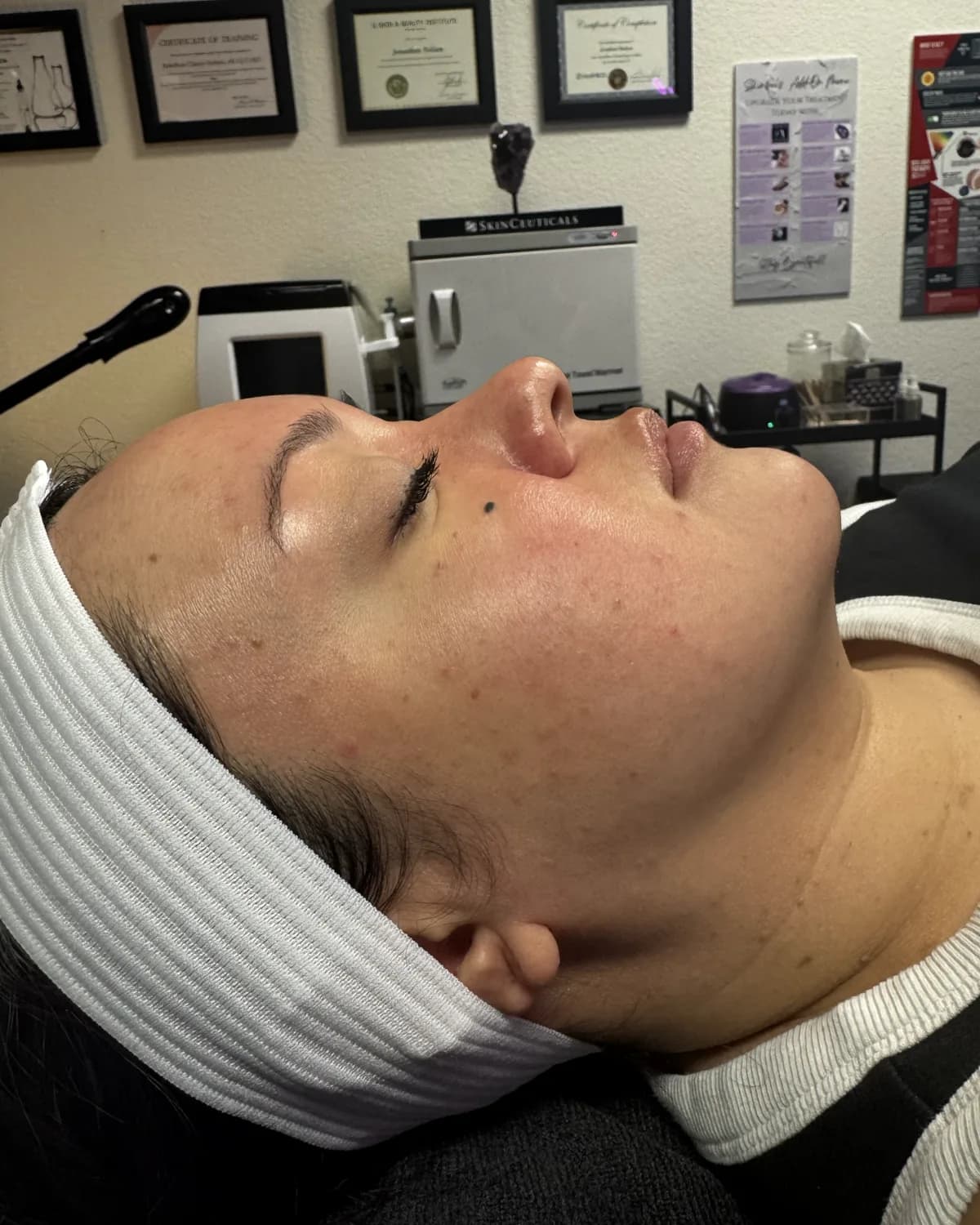 Microneedling, before treatment at AffiniDerm
