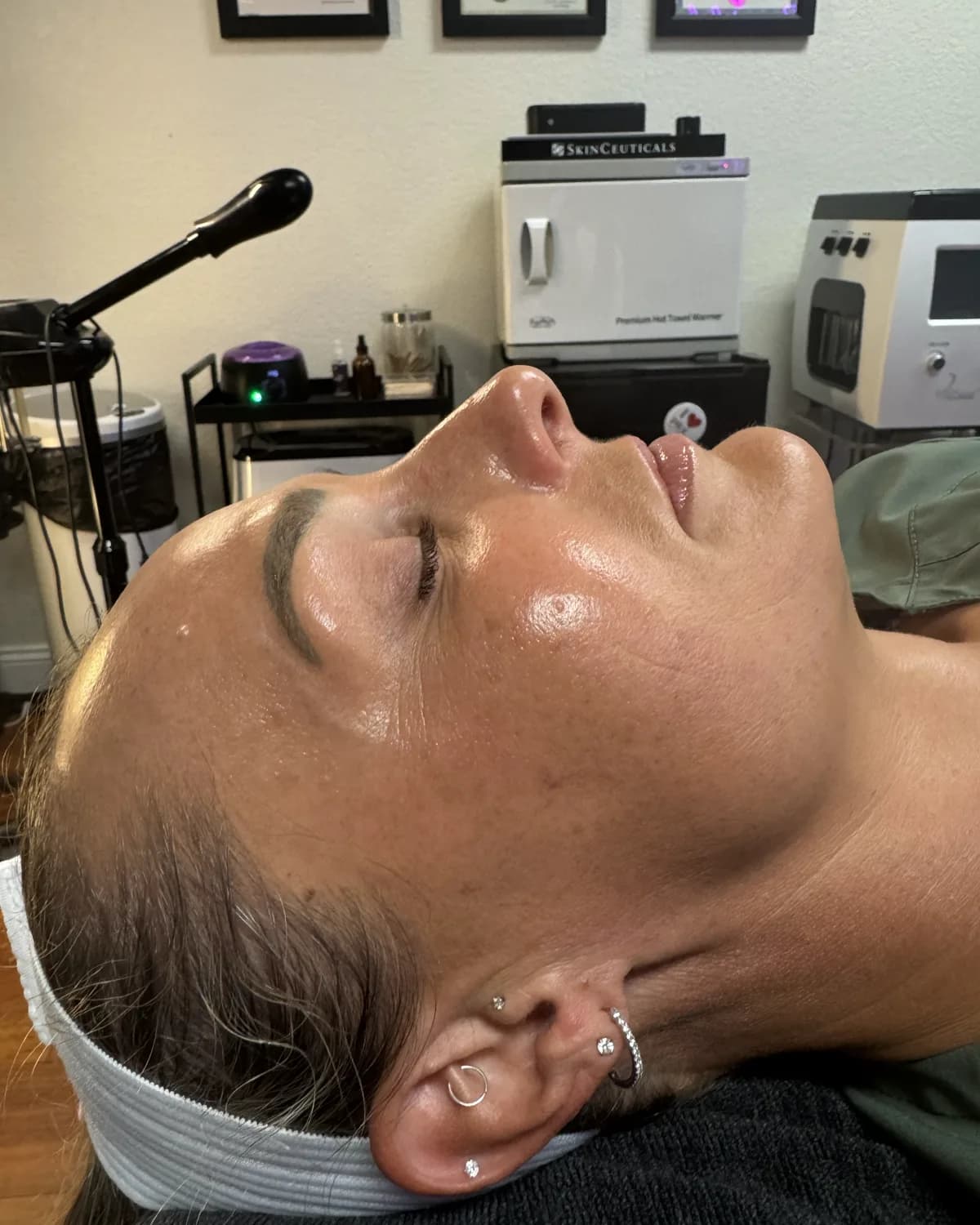 PRX Derm Perfexion, after treatment at AffiniDerm