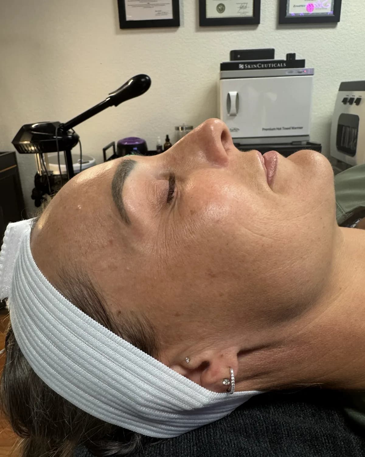 PRX Derm Perfexion, before treatment at AffiniDerm