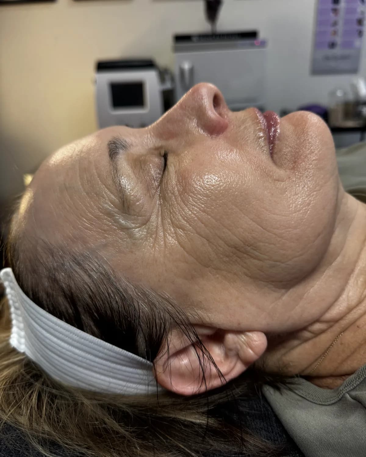 PRX Derm Perfexion, after treatment at AffiniDerm
