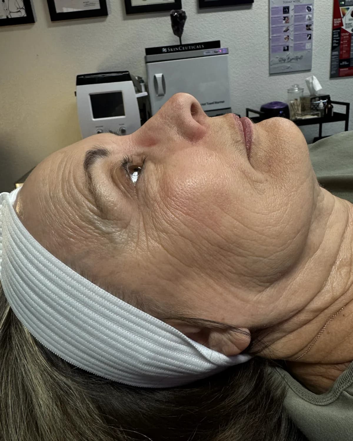 PRX Derm Perfexion, before treatment at AffiniDerm