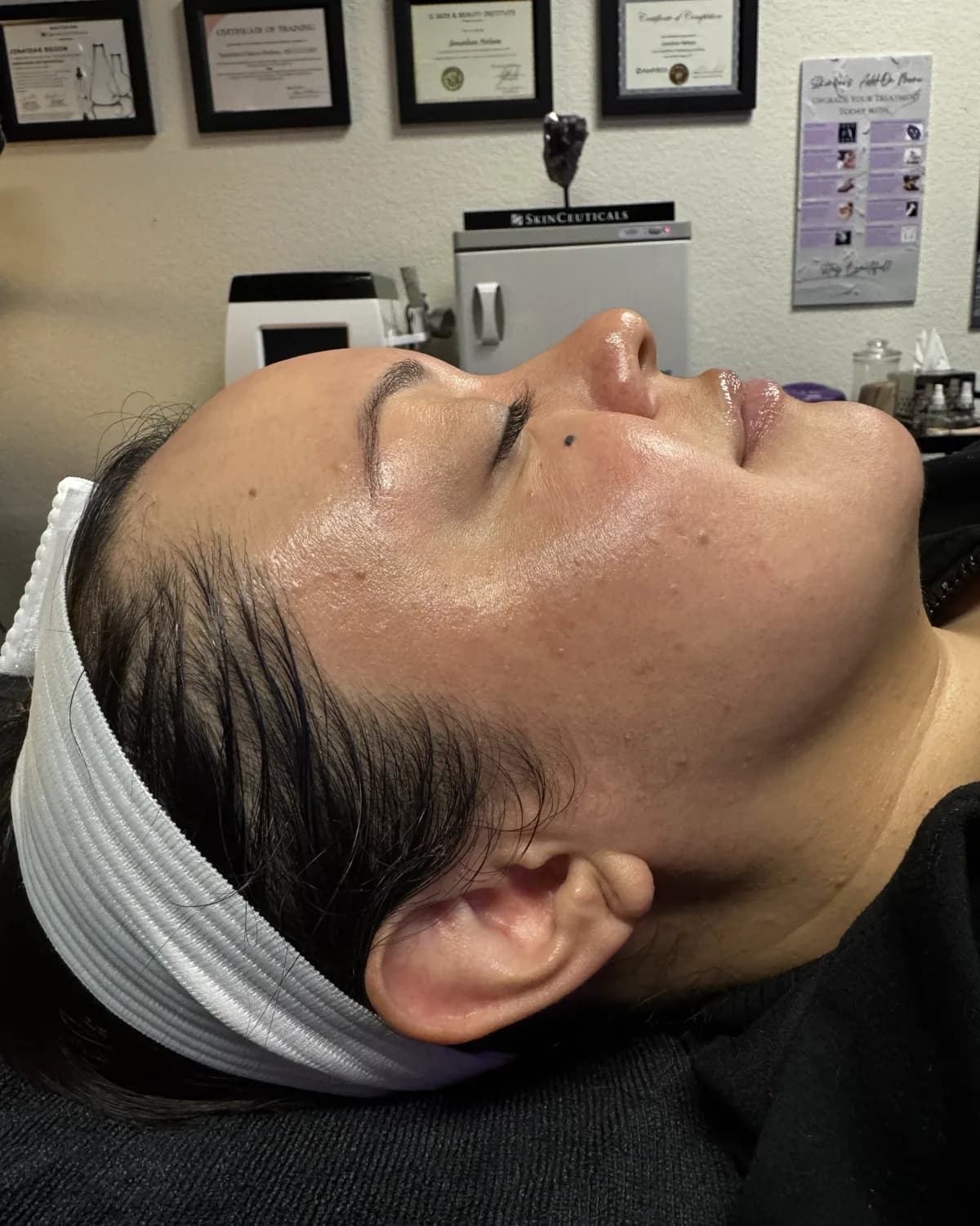 PRX Derm Perfexion, after treatment at AffiniDerm