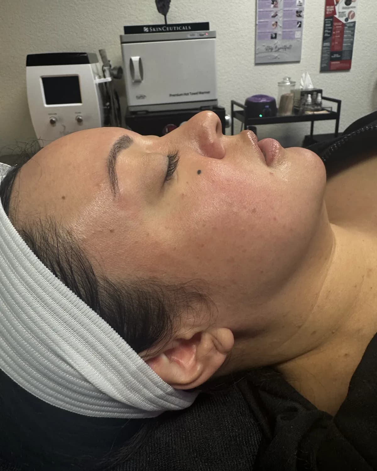 PRX Derm Perfexion, before treatment at AffiniDerm